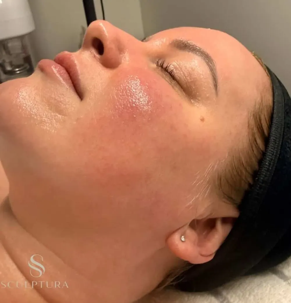 Glowing skin after a Sculptura facial in Penarth