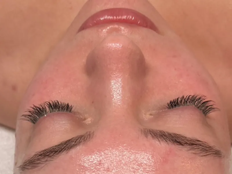 Sculptura facial: calmer, brighter, hydrated skin, after