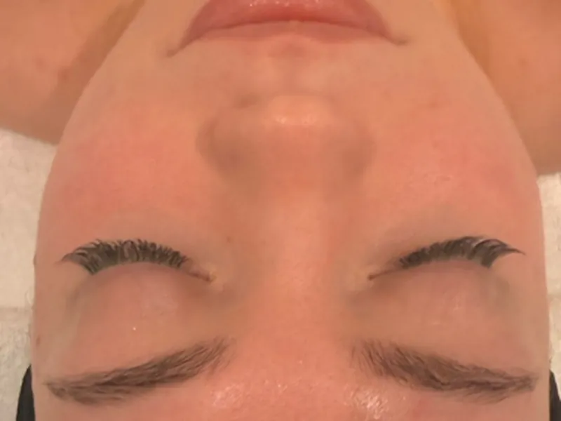 Sculptura facial: calmer, brighter, hydrated skin, before