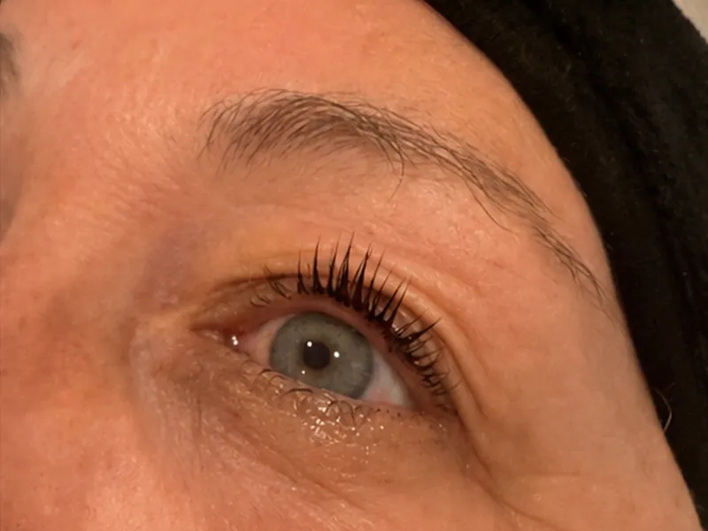 Microneedling course: smoother texture around the eye, after
