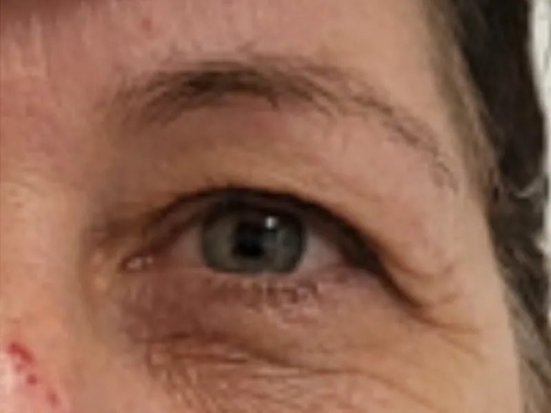 Microneedling course: smoother texture around the eye, before