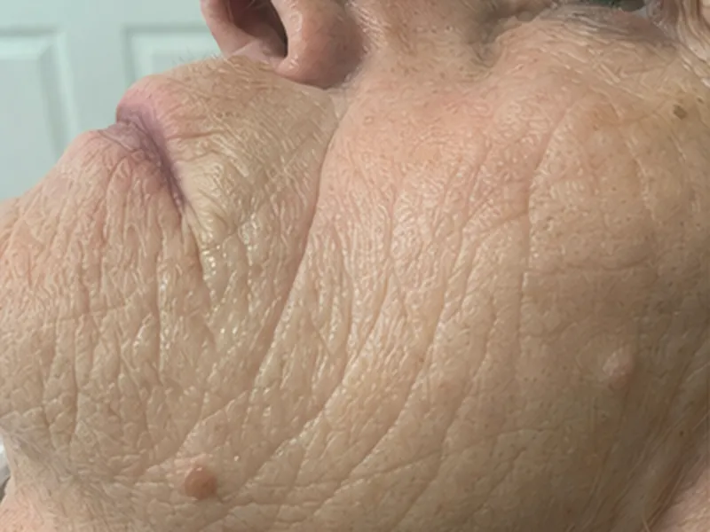 Microneedling course: softened lines and refined texture, after