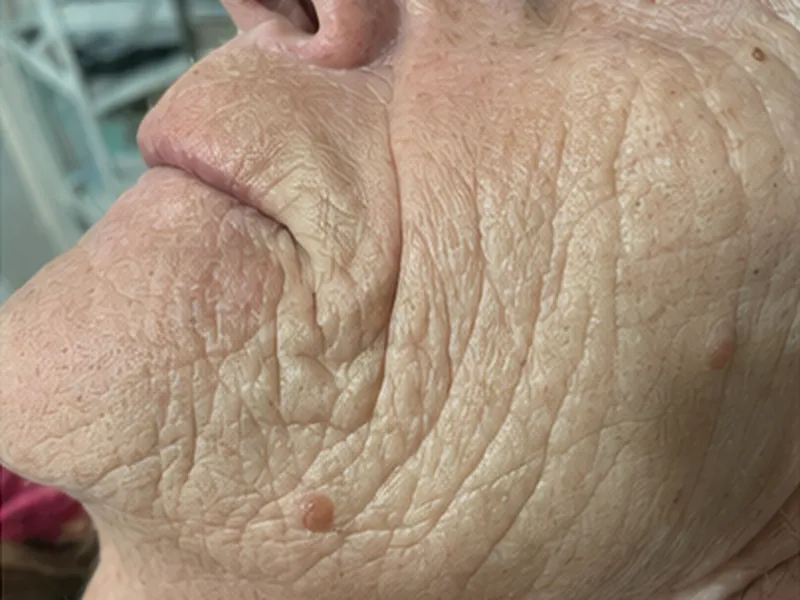 Microneedling course: softened lines and refined texture, before